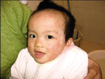 強生潤膚霜致幼兒過敏僅賠600稱產品合格(圖)