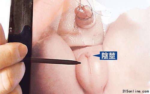 男嬰生殖器約0.2厘米長(筆指處),一粒米大小,不到平均長度2.9厘米的十分之一。圖片來源:臺灣媒體 男嬰生殖器約0.2厘米長(筆指處),一粒米大小,不到平均長度2.9厘米的十分之一。圖片來源:臺灣媒體