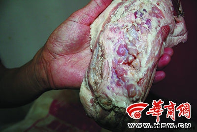 甲狀腺未摘除干凈的“雨潤問題肉” 甲狀腺未摘除干凈的“雨潤問題肉”