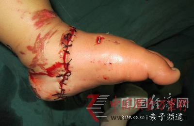 電瓶車咬斷女童左腳醫生呼吁強制安裝防護網(圖)